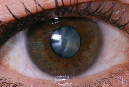 cataracts-s1-photo-of-close-up-of-eye